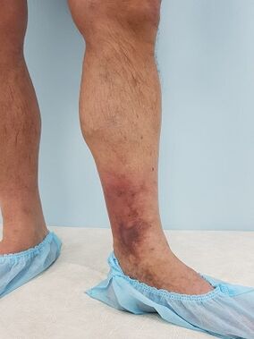 complicaciones de las venas varicosas en los hombres