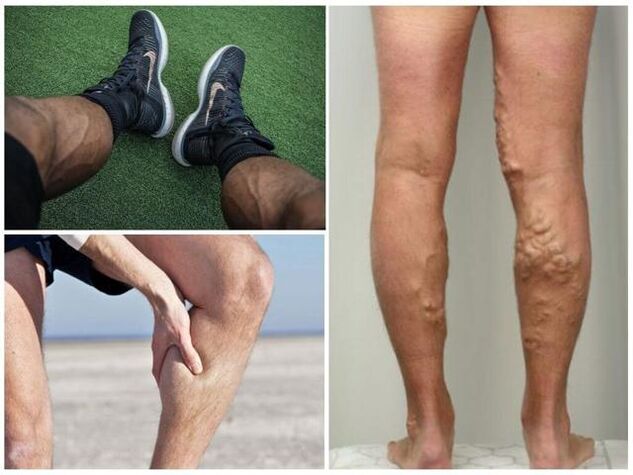 cómo se ven las venas varicosas en las piernas de los hombres
