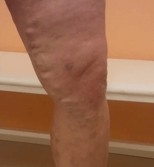 varices