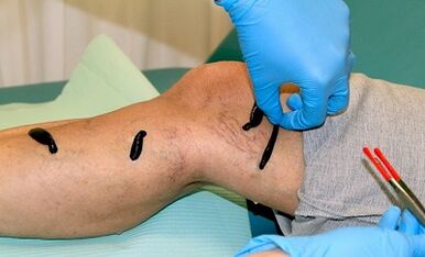 Hirudoterapia para venas varicosas