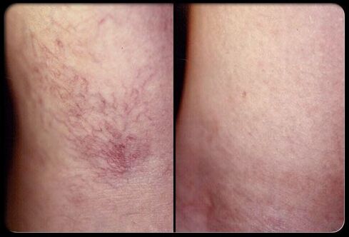 Antes y después de la escleroterapia