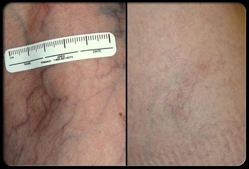 Antes y después del procedimiento de terapia con láser