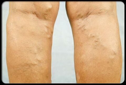 Venas varicosas en las piernas